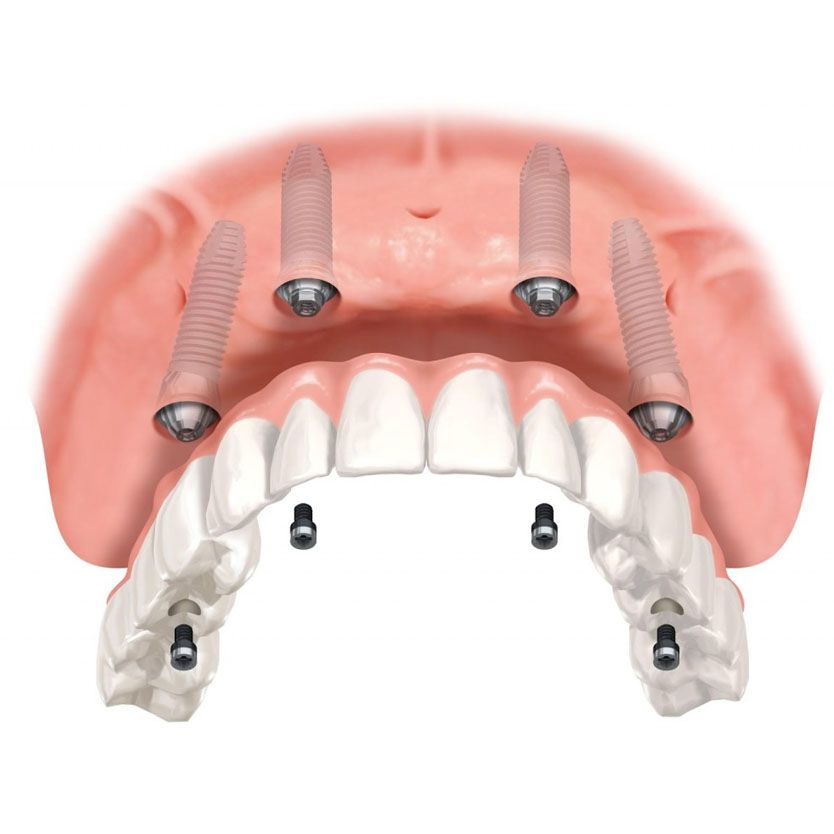 Prótese fixa sobre Implantes