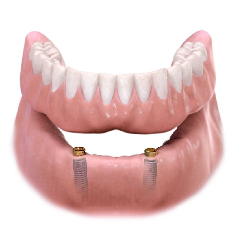 Overdenture