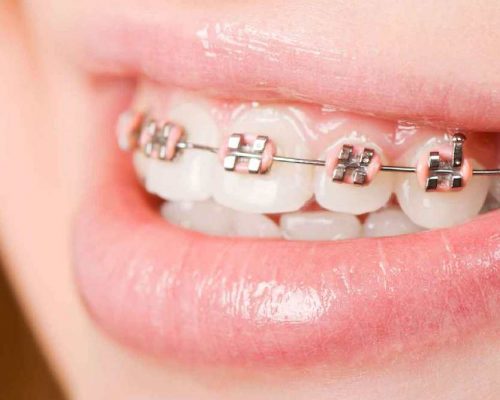 INVISALIGN – APARELHOS ORTODÔNTICOS – CAMPO GRANDE RJ – Odontocompany